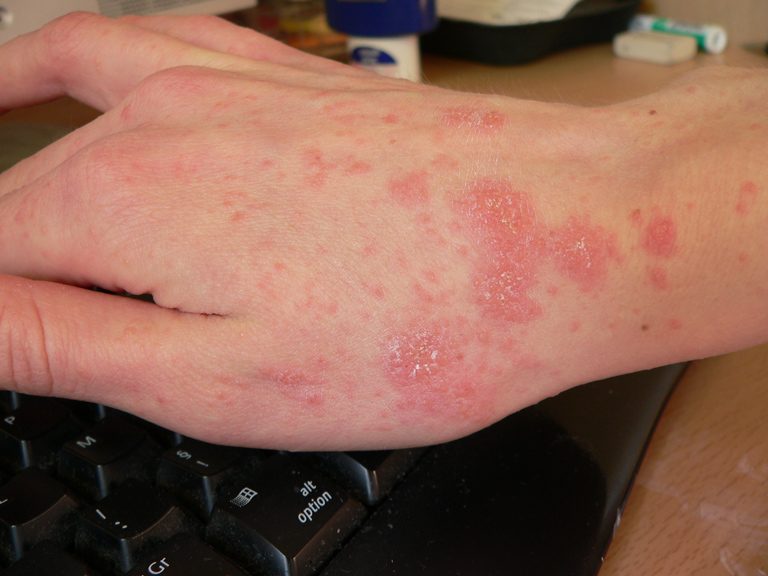 โรคหิด (Scabies) ภัยเงียบของโรคผิวหนัง